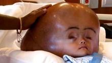 18个月的她的头部达到94厘米大，医生的一番话，让父母非常难过